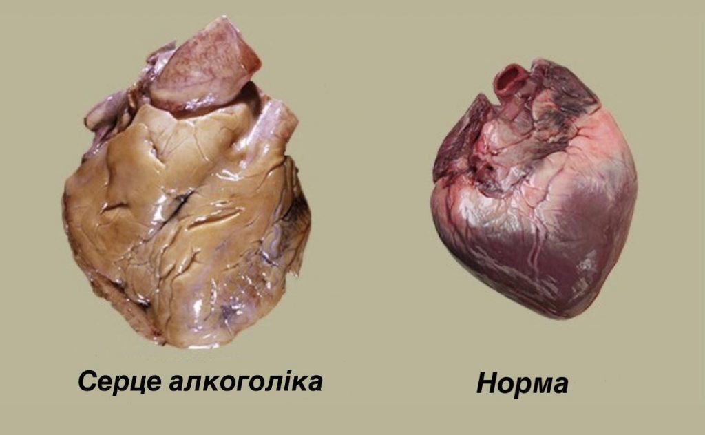 Алкоголь руйнує серце та судини